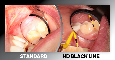 HD Black Line surgical mirrors showing superior visibility and reduced glare